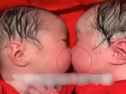 Yêu con - Cặp sinh đôi bám chặt lấy nhau khi mới chào đời, y tá không thể tách rời mà phải thốt lên: “Thật hiếm gặp”