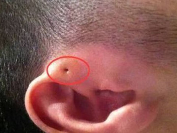 Mẹ phát hiện gần tai con xuất hiện một lỗ sâu khác thường liền tò mò bóp thử, không ngờ bác sĩ yêu cầu phẫu thuật ngay