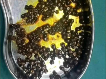 Bé gái 10 tuổi thường xuyên bỏ bữa sáng, bác sĩ phẫu thuật lấy hơn 200 viên sỏi ra khỏi dạ dày