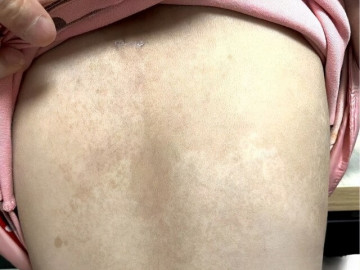 Con gái 5 tuổi có nhiều đốm nâu trên lưng, mẹ tưởng là tàn nhang nhưng đến bệnh viện bác sĩ đưa ra kết luận sốc