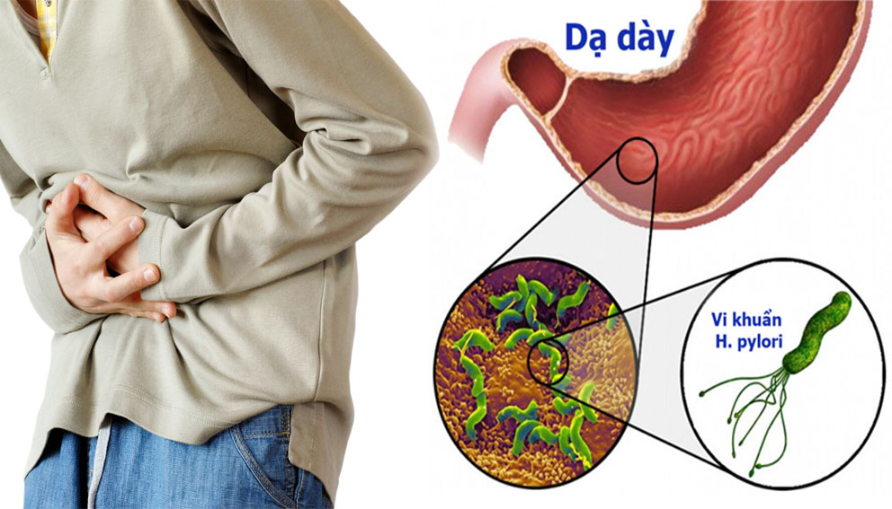 Helicobacter pylori infection là loại vi khuẩn có thể lây từ người sang người qua nước bọt, mảng bám răng hoặc đường tiêu hóa. Nhiều người nhiễm HP nhưng không có biểu hiện rõ ràng. Tuy nhiên, khoảng 5-10% trường hợp có thể xuất hiện các triệu chứng như: Đau bụng âm ỉ; Đầy hơi, khó tiêu; Buồn nôn; Ợ hơi nhiều; Mệt mỏi; Chán ăn; Táo bón hoặc rối loạn tiêu hóa. Nếu không được điều trị đúng cách, vi khuẩn này có thể làm tăng nguy cơ viêm loét dạ dày tá tràng.