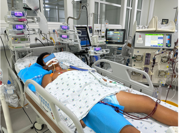 Bệnh nhân sốc nhiệt nặng, tổn thương gan, tụy, thận cấp. Ảnh: BVCC