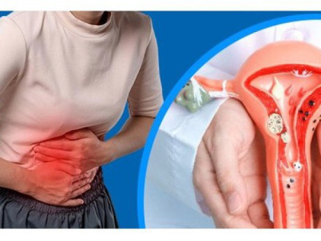 7 dấu hiệu thường gặp của lạc nội mạc tử cung chị em nên chú ý