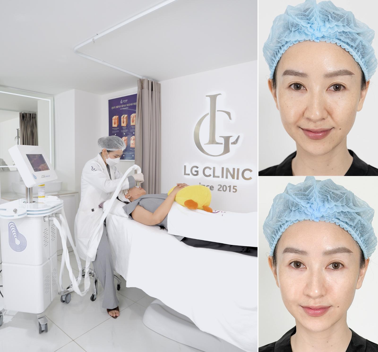 Hoa hậu Hà Thu sở hữu gương mặt tươi trẻ sau liệu trình nâng cơ CFU Èlife tại LG Clinic