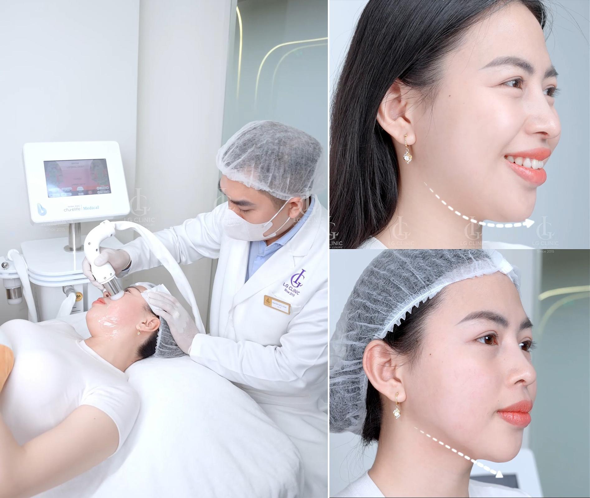 Cận cảnh gương mặt thon gọn, đường viền hàm sắc nét của Hoa hậu Lê Minh Thư sau khi điều trị CFU Èlife tại LG Clinic