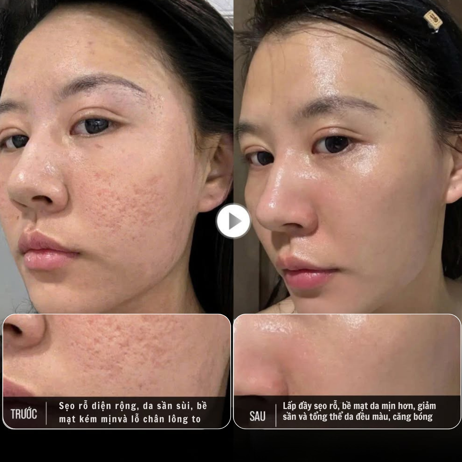 Liệu trình điều trị sẹo rỗ tại Phòng khám Da liễu LG ghi nhận hiệu quả cải thiện rõ rệt