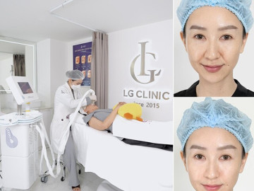 Nguyên nhân nhiều hoa hậu lựa chọn LG Clinic để xóa rãnh cười, thon gọn khuôn mặt
