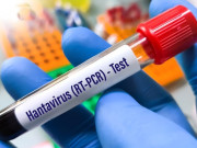 Sức khỏe - Hantavirus - bệnh dễ nhầm với cúm nhưng chuyển nặng nhanh
