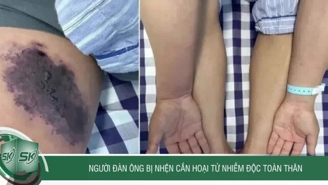 Người đàn ông bị nhện cắn hoại tử nhiễm độc toàn thân