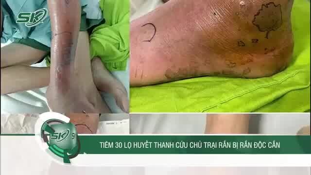 Tiêm 30 lọ huyết thanh cứu người chủ bị rắn độc cắn