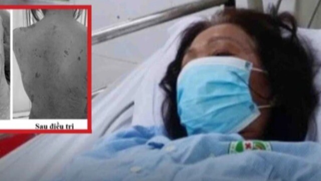 Tự ý dùng thuốc, người phụ nữ sốc nặng khi da bị tróc như 'cua lột'