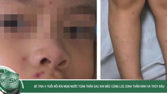 Bé trai 4 tuổi nổi kín mụn nước toàn thân sau khi mắc cùng lúc zona thần kinh và thủy đậu