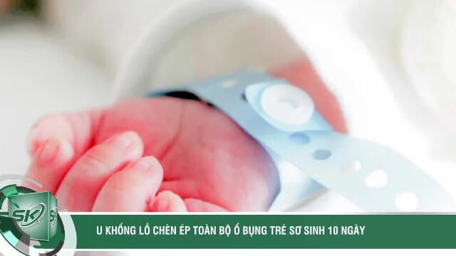 Cứu trẻ sơ sinh 10 ngày tuổi mang khối u hiếm gặp, chèn ép toàn bộ ổ bụng