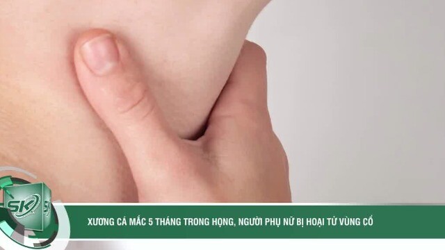 Xương cá nằm trong họng 5 tháng gây áp xe hoại tử vùng cổ