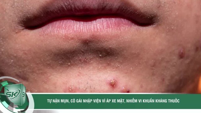 Tự nặn mụn quanh môi, cô gái nhập viện vì áp xe mặt, nhiễm vi khuẩn kháng thuốc