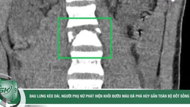 Đau lưng kéo dài, người phụ nữ phát hiện khối bướu máu đã phá hủy gần toàn bộ đốt sống