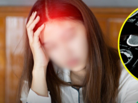 Đau đầu dai dẳng không rõ nguyên nhân, người phụ nữ nhận chẩn đoán ít ai ngờ