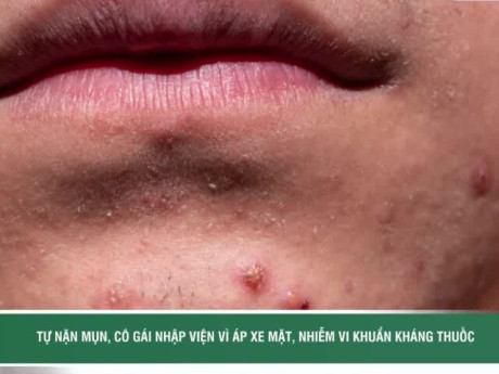 Tự nặn mụn quanh môi, cô gái nhập viện vì áp xe mặt, nhiễm vi khuẩn kháng thuốc