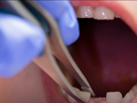 Được mẹ nhổ răng tại nhà, bé trai 9 tuổi bất ngờ hít luôn chiếc răng vào phổi