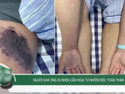 Clip Eva - Người đàn ông bị nhện cắn hoại tử nhiễm độc toàn thân