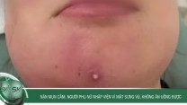 Nặn mụn cằm, người phụ nữ nhập viện vì mặt sưng vù, không ăn uống được