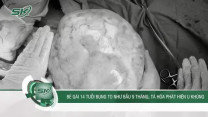 Bé gái 14 tuổi bụng to như bầu 9 tháng, bác sĩ phát hiện u khủng
