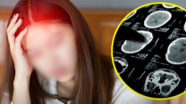Đau đầu dai dẳng không rõ nguyên nhân, người phụ nữ nhận chẩn đoán ít ai ngờ