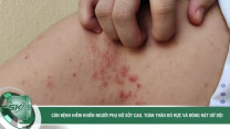 Căn bệnh hiếm khiến người phụ nữ sốt cao, toàn thân đỏ rực và bỏng rát dữ dội