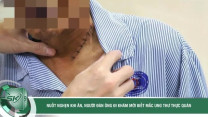 Nuốt nghẹn khi ăn, không ngờ phát hiện mắc ung thư thực quản xâm lấn nguy hiểm