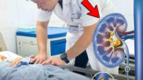 Người phụ nữ 29 tuổi hỏng thận, buộc phải cắt bỏ chỉ vì chủ quan với cơn đau lưng kéo dài