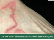 Clip Eva - Ngứa khắp người nhiều tháng, bất ngờ phát hiện nhiễm cùng lúc sán lá gan và giun lươn