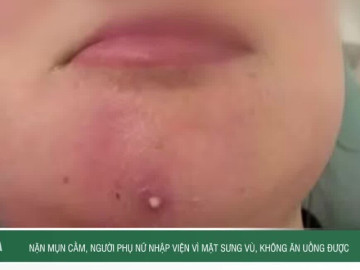 Nặn mụn cằm, người phụ nữ nhập viện vì mặt sưng vù, không ăn uống được