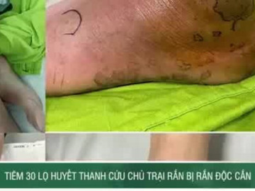 Tiêm 30 lọ huyết thanh cứu người chủ bị rắn độc cắn