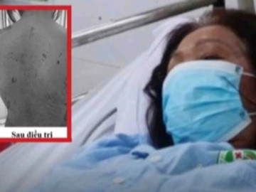 Tự ý dùng thuốc, người phụ nữ sốc nặng khi da bị tróc như 'cua lột'