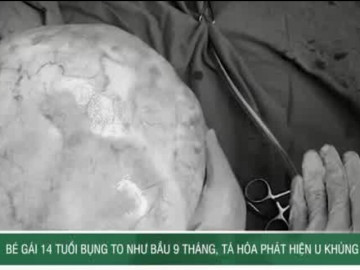 Bé gái 14 tuổi bụng to như bầu 9 tháng, bác sĩ phát hiện u khủng