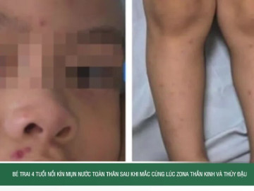 Bé trai 4 tuổi nổi kín mụn nước toàn thân sau khi mắc cùng lúc zona thần kinh và thủy đậu