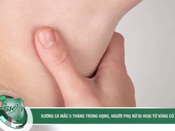 Xương cá nằm trong họng 5 tháng gây áp xe hoại tử vùng cổ