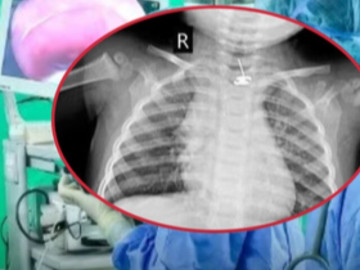 Nuốt phải bông tai kim loại, bé gái 11 tháng tuổi đối mặt nguy cơ thủng thực quản