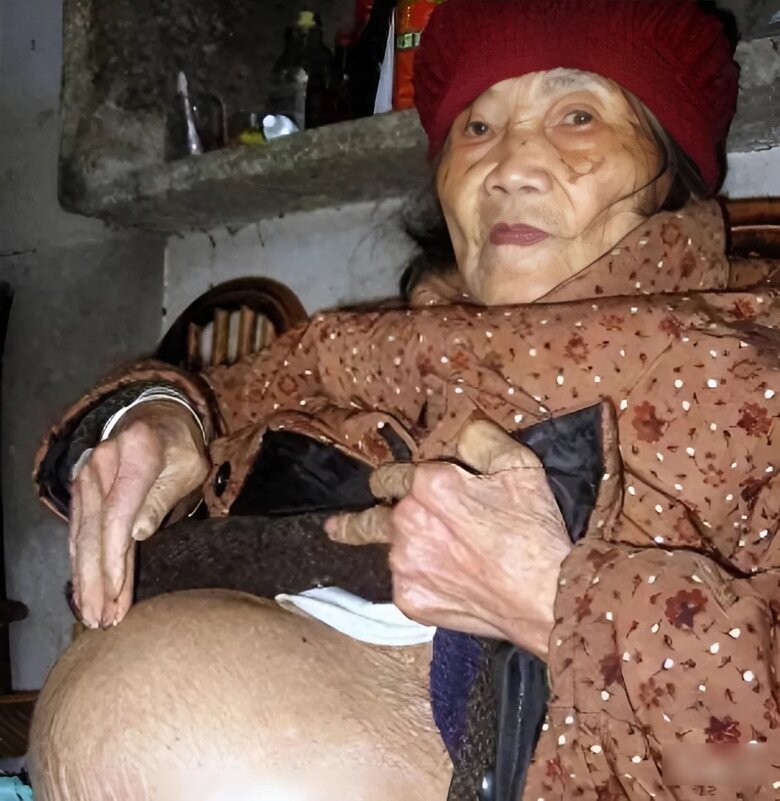 Cụ bà 91 tuổi phát hiện bụng phình to, con trai đưa đi khám mới phát hiện mang thai đá.