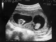 Bà bầu - Bị thai nhi đá vào bụng đau điếng phải vào viện siêu âm, thông báo từ bác sĩ khiến bà bầu mừng như "trúng số độc đắc"