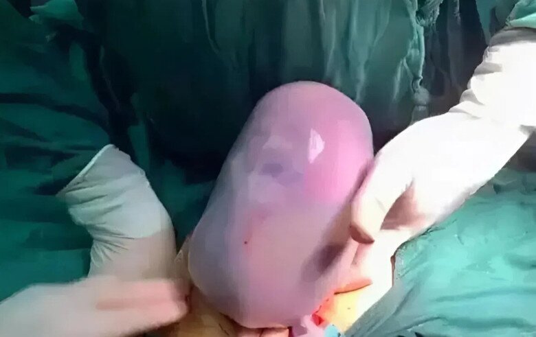 Em bé chào đời nhìn như một khối thạch khiến bố mẹ sững sờ.
