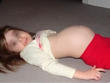 Bà bầu - Con gái 12 tuổi đi học về bụng phình to bất thường, kết quả chụp CT tại bệnh viện khiến bố mẹ sợ hãi