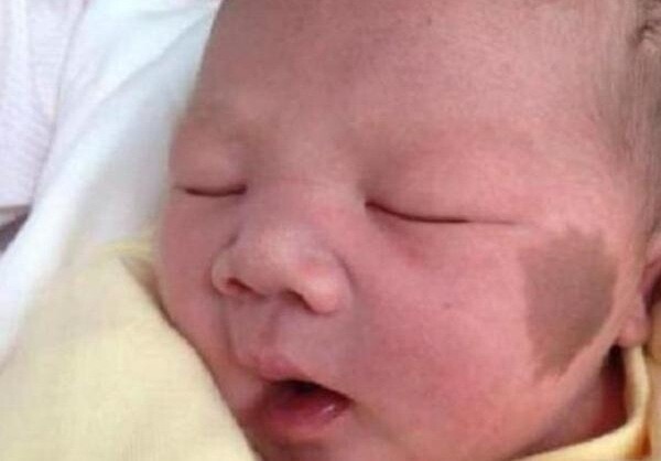 Bé sơ sinh chào đời có vết bớt trên mặt, bác sĩ: Có thể do đã xảy ra những tình huống này trong thai kỳ - 1