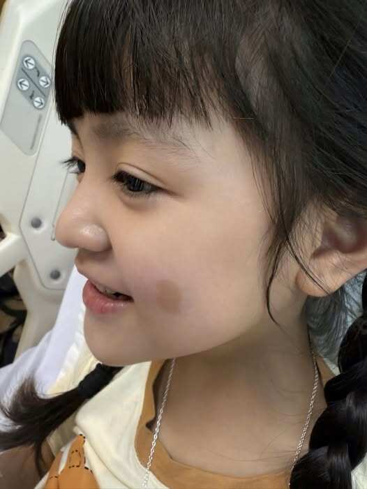 Hình ảnh vết bớt mờ trên má bé An Nhiên.