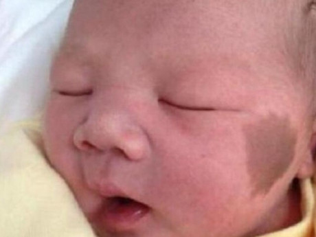 Bé sơ sinh chào đời có vết bớt trên mặt, bác sĩ: Có thể do đã xảy ra những tình huống này trong thai kỳ