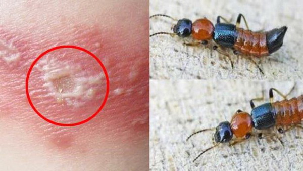 Tổn thương do kiến ba khoang rất dễ nhầm lẫn với zona thần kinh nên nhiều người xử lý sai cách. Ảnh minh họa.