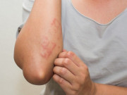 Sức khỏe - Thiếu nữ tổn thương nhiều vùng cơ thể vì loại vật nuôi quen thuộc, bác sĩ cảnh báo nguy cơ khi thời tiết nắng nóng