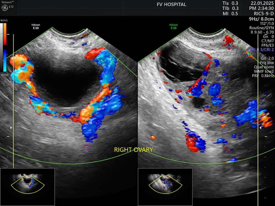 Hình siêu âm tái khám sau 1 tuần: bên trái buồng trứng xoắn, bên phải buồng trứng đã được tưới máu lại bình thường sau phẫu thuật. (Ảnh: FV)