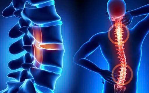 Sáng cứng cổ, chiều mỏi lưng: Khi đau cột sống trở thành vấn đề cần chăm sóc lâu dài - 1