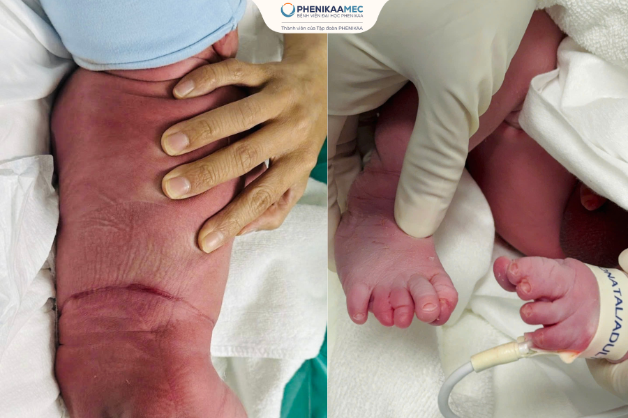 Em bé chào đời với dấu vết dải xơ ngang bụng và chân, không ảnh hưởng đến sức khỏe